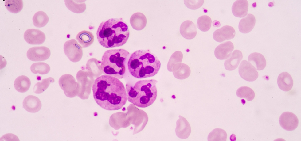 hypersegmented neutrophils high low meaning
